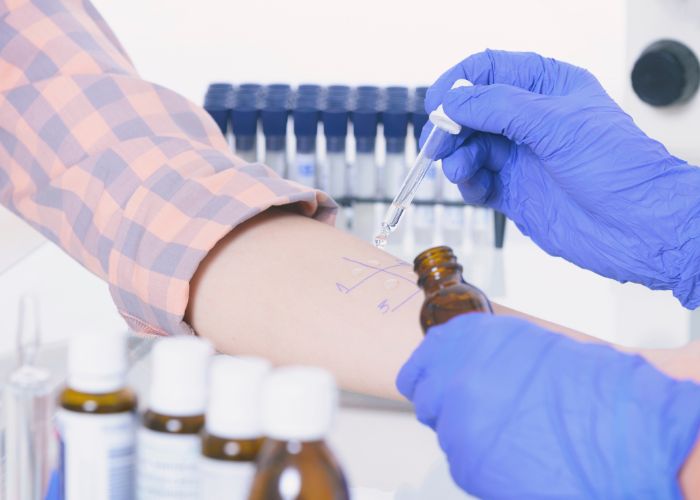 CZ Alergie Prick Test 1
