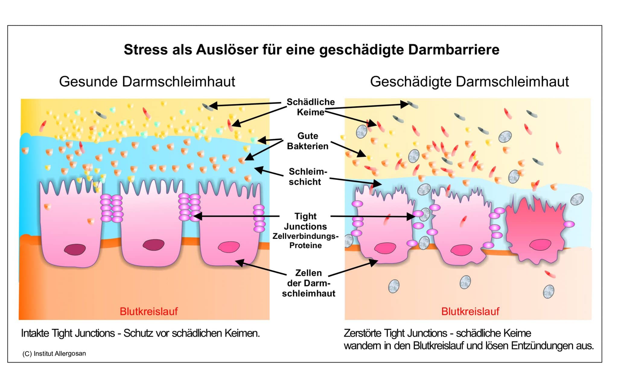 Leaky Gut: der löchrige Darm - OMNi-BiOTiC® | AT