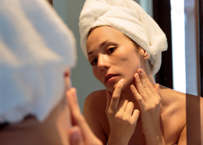 Frau mit Hautproblemen betrachtet sich im Spiegel - wie hängt Stress mit der Haut zusammen?