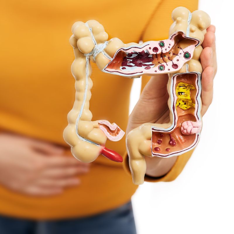 Was sind chronisch entzündliche Darmerkrankungen? Colitis Ulcerosa und Morbus Crohn - eine Frau hält sich den Bauch und zeigt eine Darstellung eines angegriffenen Darms auf