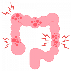 Morbus Crohn: grafische Darstellung eines betroffenen Darms