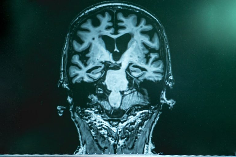 Alzheimer MRT
