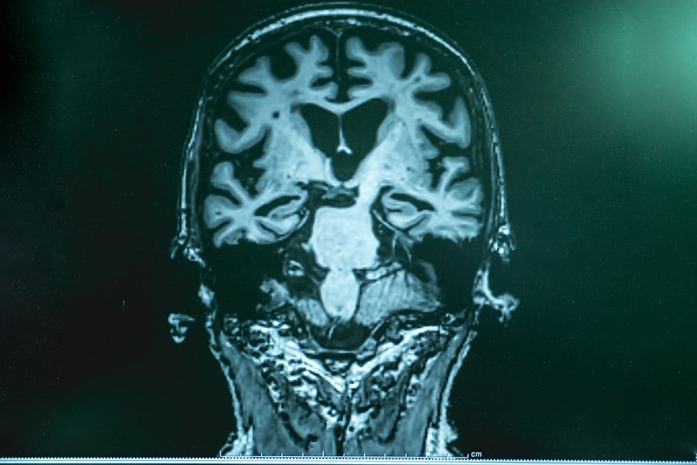 Alzheimer MRT