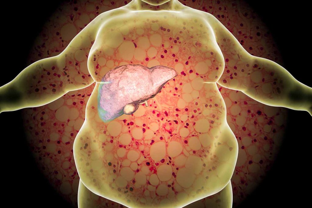 Mikrobiom und Metabolisches Syndrom 4 Krankmachende Ernährung – kranker Darm?