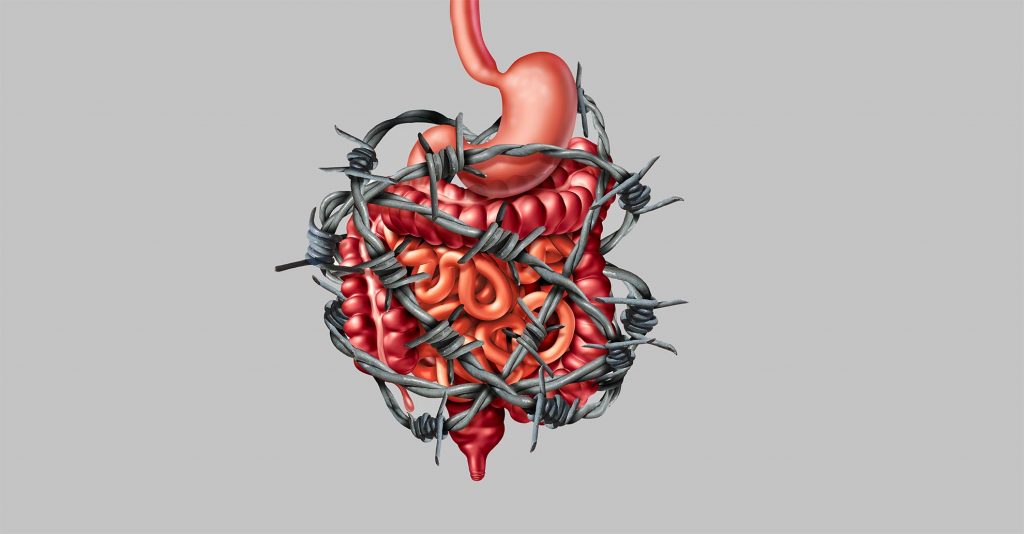 irritable bowel syndrome