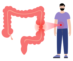 sintomas intestino irritable rds