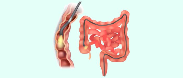 darmspiegelung kamera darm