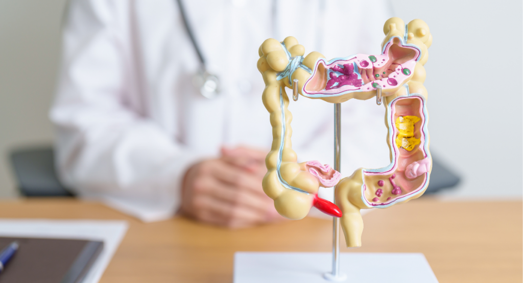 diverticule, diverticulose, sigmoïdite : côlon et troubles digestifs
