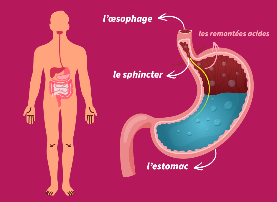 Remontées acides, reflux, brûlures d'estomac : définitions et causes