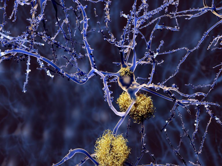 alzheimer 2 kopie 2