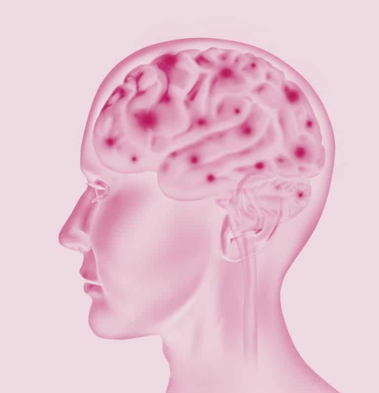 alzheimerova choroba 1
