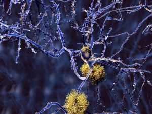 Enge Beziehung zwischen Alzheimer & Darmflora